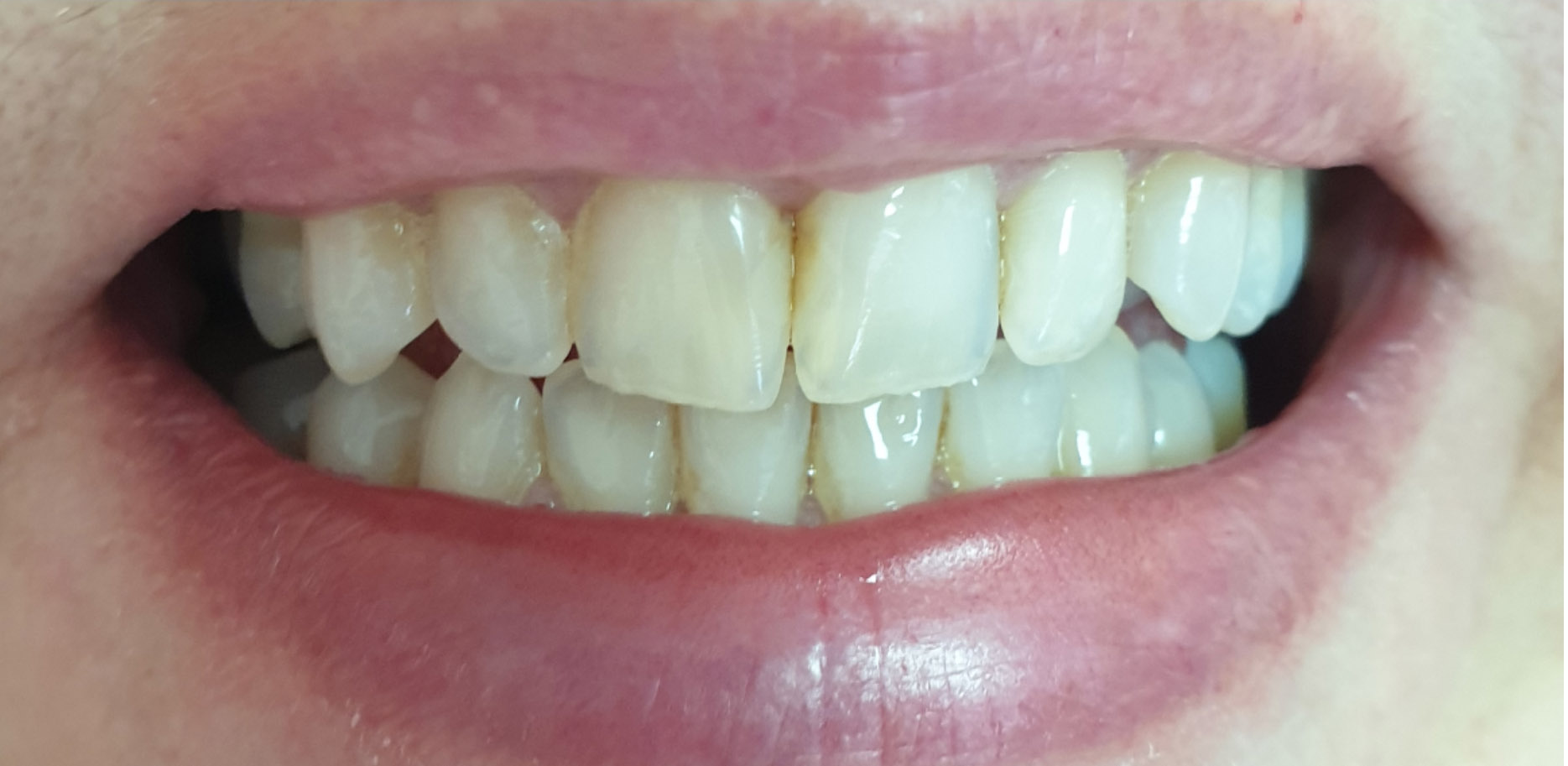 Prije tretmana